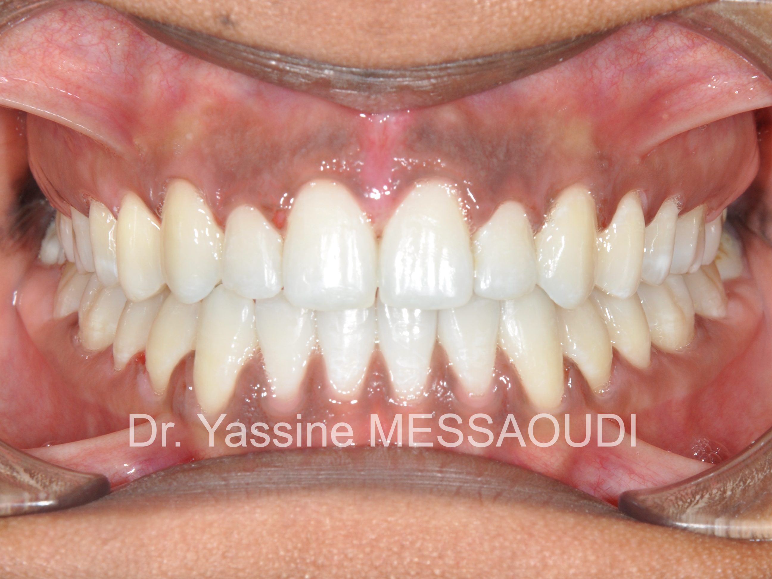 Diastèmes - Après traitement